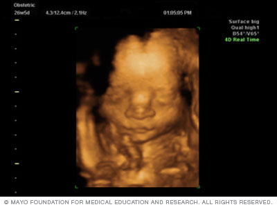 3D Ultrasound 3D Ultrasound